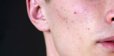 Derisinde sivilceler olan bir adam. Sivilce ve sivilce. Dermatoloji, ergen adam. Sivilce problemi. Sivilceli genç adam. Cilt bakım, sivilce problemi. Guy Sivilce Surat, kapat.