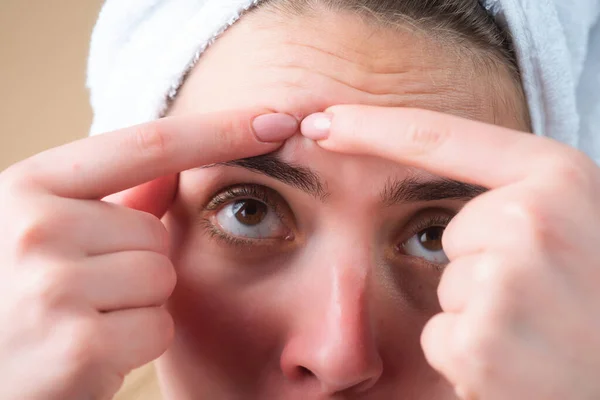 Acne Close Acne Pimple Female Skin Dermatology Puberty Woman Skin — Stock Photo, Image