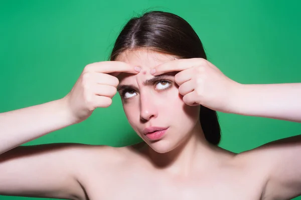 Mulher Jovem Com Pústula Acne Squeeze Out Pimples Acne Pele — Fotografia de Stock