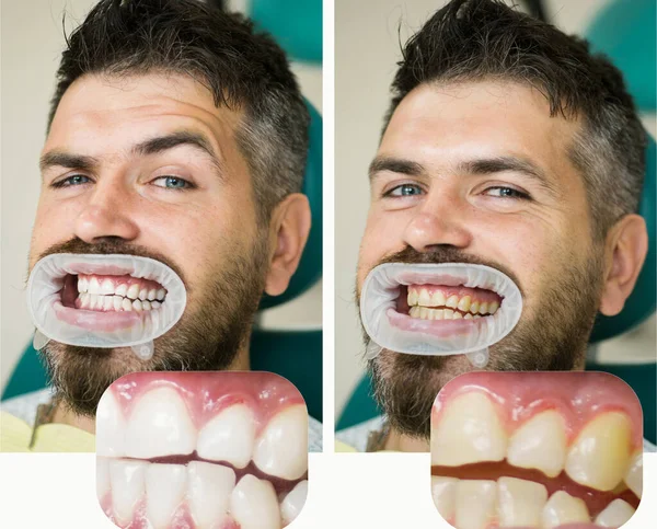 Whitening Man Dental Chair Dentist Preparing Dental Whitening Health Medicine — Stock Photo, Image