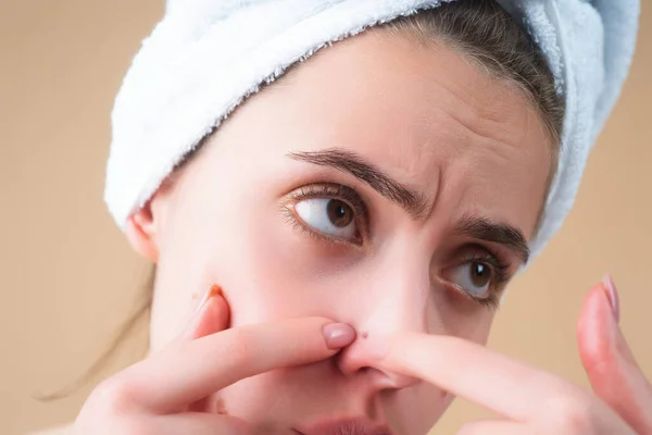 Akné Zblízka Akné Pupínek Ženské Kůži Dermatologie Puberta Kožní Reakce — Stock fotografie