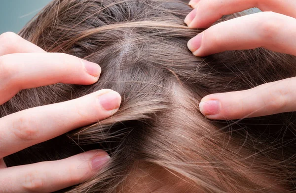 Hair Loss Close Tangled Problem Hair Macro — Stock Photo, Image
