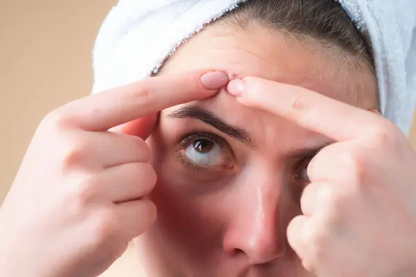 Zamknij Kobieta Wycisnąć Pryszcze Czole Trądzik Pryszcz Skórze Dermatologia Dojrzewająca — Zdjęcie stockowe