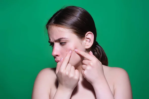 悲しい女性は頬にきびを絞る 皮膚にアクネおよびピンプル デマトロジー 思春期の女性 皮膚の問題について 女の子は肌の頬にピンプルを絞ります 皮膚の問題からのケア ピンプルフェイス — ストック写真