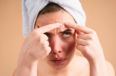 Yüzünde sivilceler olan bir kadın. Sivilce lekeleri genç bir kadında deri lekesi. Benekli sivilce, çiller ve melasma pigmentasyonu yüz bakımı, sorunlu cilt konsepti.
