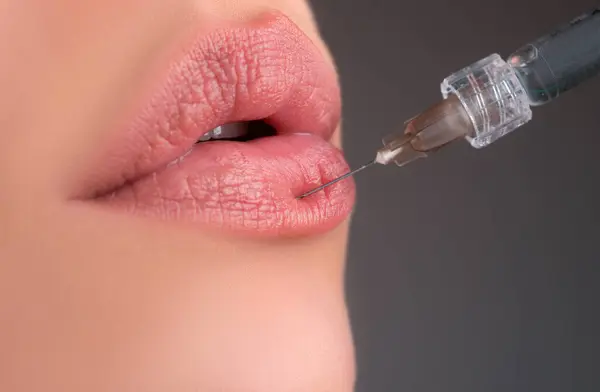 Dudak Büyütme Kadın Ağzı Şırıngası Hyaluronik Asit Enjeksiyonu Yaş Değişir — Stok fotoğraf