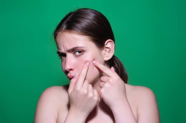 Üzgün kadın yanaklarından sivilceler çıkarıyor. Sivilce ve sivilce. Dermatoloji, ergenlik çağındaki kadın. Sivilceler cilt problemi. Deri yanağından sivilce çıkıyor. Cilt sorunundan korunma. Sivilceli surat.