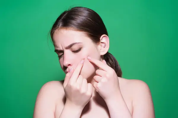 クローズアップ 女性は頬にきびを絞り出します 皮膚にアクネおよびピンプル デマトロジー 思春期の女性 皮膚の問題について 女の子は肌の頬にピンプルを絞ります 皮膚の問題からのケア ピンプルフェイス — ストック写真