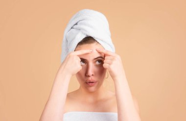 Yüzüne sivilce çıkaran güzel bir kız. Sivilce lekeleri genç bir kadında deri lekesi. Benekli sivilce, çiller ve melasma pigmentasyonu yüz bakımı, sorunlu cilt konsepti.