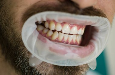 Genç adam diş hekimi, diş rengini seçme. Kadın dişçi ile modern diş kliniği aynada hasta diş kontrol. Kar beyaz dişler ile neşeli erkek kişi portresi