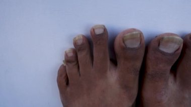 14 Ekim 2022 Uttarakhand, Hindistan. Hijyenik olmayan ayak hastalıkları olan Hintli bir yetişkinin ihmal edilmiş ayak tırnakları. Kişisel bakım ve kişisel hijyen kavramı.
