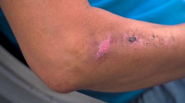 Hintli bir erkeğin ön kolundaki iyileşme yarasının yakın çekimi doğal iyileşme sürecini gösteriyor. Tıbbi günlükler ve belgeler için ideal.