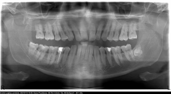 Panoramic dental X-Ray of man