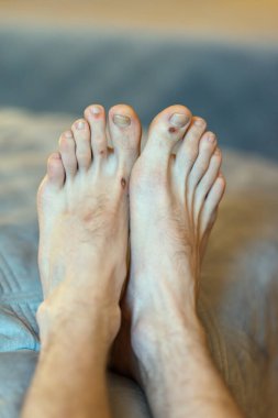 Derisi aşınmış ve bacakları çizilmiş. Parmaklarda nasırlar. Kan akıyor. Yaralanmadan sonra cilt bakımı, çürük, düşüş, çizik. Kötü ekipman kullandıktan sonra bacakların derisinde sorun var. Yüksek kalite fotoğraf