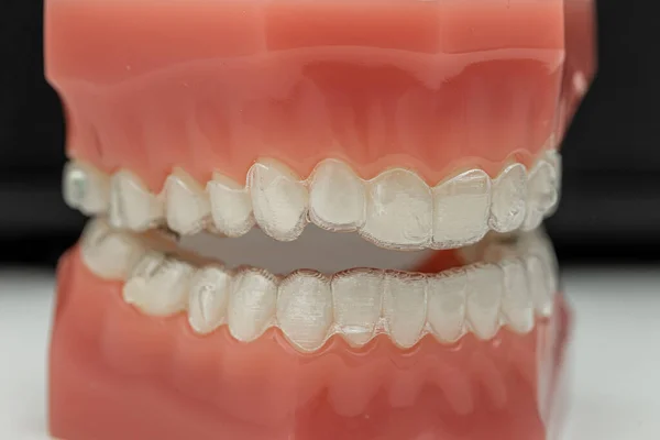 歯のアライメントのための目に見えない取り外し可能なアライナー — ストック写真