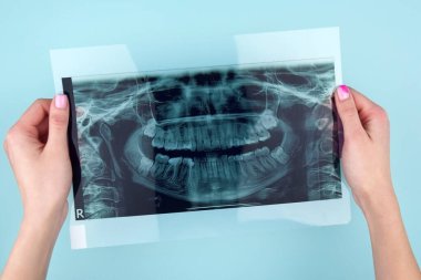 Hastanın dişini çeken bir dişçi. Açık mavi arkaplan üzerinde çene panoramik çekim.