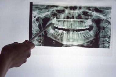 Çenenin panoramik görüntüsü hastanın dişleri açık mavi arkaplanda.