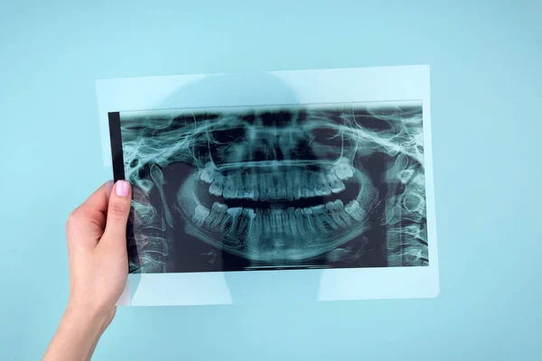 stock image A dentist holding snapshot the patient's tooth. Panoramic shot of the jaw on a light blue background.