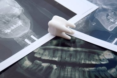 Çenenin panoramik görüntüsü hastanın dişleri açık mavi arkaplanda.