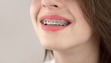 Diş teli takmış genç bir kızın portresi. Isırık dizilimi. Güzel bir gülümseme üzerinde çalışıyorum. Ortodonti, dişçilik.
