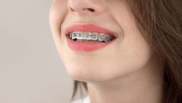 Portrait of a young girl with braces. Bite alignment. Working on a beautiful smile. Orthodontics, dentistry.