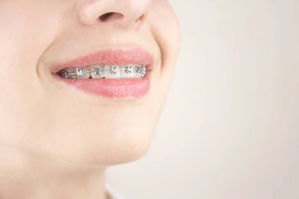 Portrait Young Girl Braces Bite Alignment Working Beautiful Smile Orthodontics — Stock Photo, Image
