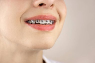 Diş teli takmış genç bir kızın portresi. Isırık dizilimi. Güzel bir gülümseme üzerinde çalışıyorum. Ortodonti, dişçilik.
