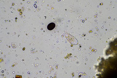 İnsan paraziti. Bağırsak enfeksiyonu. hastanede insanlarda mikroorganizma enfeksiyonu