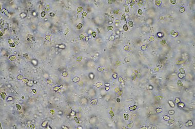 Virüs ve bakteri enfeksiyonundan kaynaklanan bir göğüs enfeksiyonundan mukus ve balgam çıkarmak, mikroskop altında, hücreler ve mikroorganizmalarla bakmak. Bakteri ve deri hücreleri