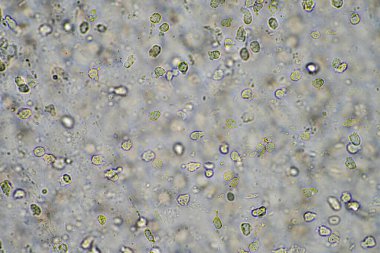 Virüs ve bakteri enfeksiyonundan kaynaklanan bir göğüs enfeksiyonundan mukus ve balgam çıkarmak, mikroskop altında, hücreler ve mikroorganizmalarla bakmak. Bakteri ve deri hücreleri