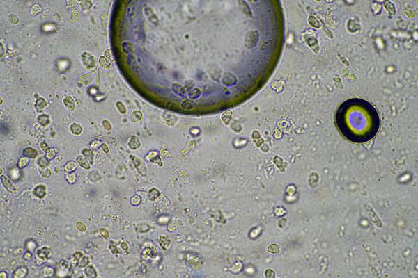 Coughing up mucus and phlegm from a chest infection from a virus and bacteria infection, looking at it under the microscope, with cells and microorganisms. Bacteria and skin cells