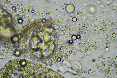 yeşil mukus ve mikroskop altında öksürme grip hücrelerine ve Avustralya 'da hasta olan bir insanın soğuk sümüğüne bakıyor.