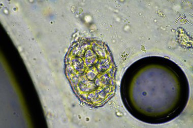 yeşil mukus ve mikroskop altında öksürme grip hücrelerine ve Avustralya 'da hasta olan bir insanın soğuk sümüğüne bakıyor.