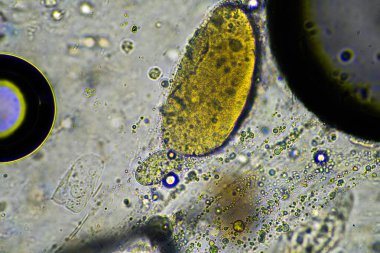 yeşil mukus ve mikroskop altında öksürme grip hücrelerine ve Avustralya 'da hasta olan bir insanın soğuk sümüğüne bakıyor.