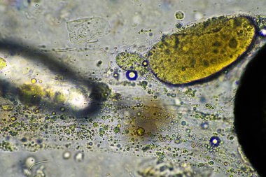 Virüs ve bakteri enfeksiyonundan kaynaklanan bir göğüs enfeksiyonundan mukus ve balgam çıkarmak, mikroskop altında, hücreler ve mikroorganizmalarla bakmak. Bir insanda bakteri ve deri hücreleri