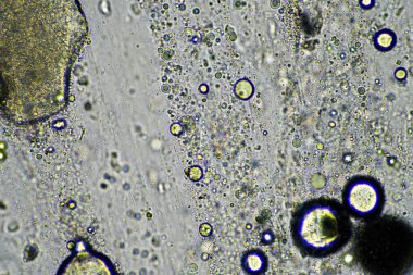 Virüs ve bakteri enfeksiyonundan kaynaklanan bir göğüs enfeksiyonundan mukus ve balgam çıkarmak, mikroskop altında, hücreler ve mikroorganizmalarla bakmak. Bir insanda bakteri ve deri hücreleri