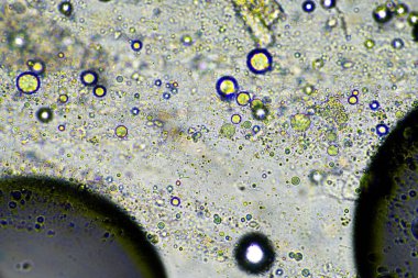 yeşil mukus ve mikroskop altında öksürme grip hücrelerine ve Avustralya 'da hasta olan bir insanın soğuk sümüğüne bakıyor.