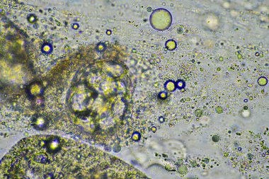 yeşil mukus ve mikroskop altında öksürme grip hücrelerine ve Avustralya 'da hasta olan bir insanın soğuk sümüğüne bakıyor.