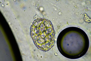 yeşil mukus ve mikroskop altında öksürme grip hücrelerine ve Avustralya 'da hasta olan bir insanın soğuk sümüğüne bakıyor.