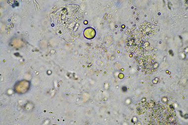 yeşil mukus ve mikroskop altında öksürme grip hücrelerine ve Avustralya 'da hasta olan bir insanın soğuk sümüğüne bakıyor.