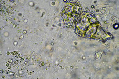 Virüs ve bakteri enfeksiyonundan kaynaklanan bir göğüs enfeksiyonundan mukus ve balgam çıkarmak, mikroskop altında, hücreler ve mikroorganizmalarla bakmak. Bir insanda bakteri ve deri hücreleri