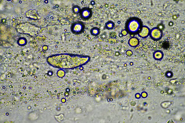 ウイルスやバクテリア感染による胸の感染症から粘液やフィグムを咳 細胞や微生物を使って顕微鏡の下で見ます 人間の細菌と皮膚細胞 — ストック写真