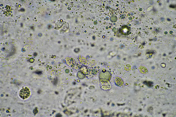 Кашель Слизи Мокроты Инфекции Грудной Клетки Вируса Бактерий Глядя Микроскопом — стоковое фото