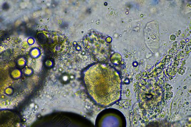 Virüs ve bakteri enfeksiyonundan kaynaklanan bir göğüs enfeksiyonundan mukus ve balgam çıkarmak, mikroskop altında, hücreler ve mikroorganizmalarla bakmak. Bir insanda bakteri ve deri hücreleri