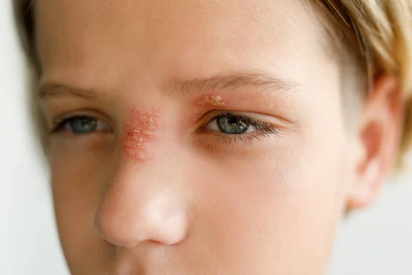 Large red rash on the nose and over the child's eye - dermatolonia, virus, infection, herpes, mucous membrane, selective focus