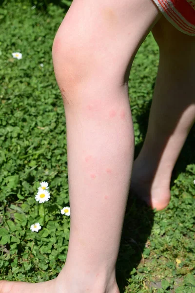 stock image Multiple blisters on a girl's leg caused by mosquito bites.