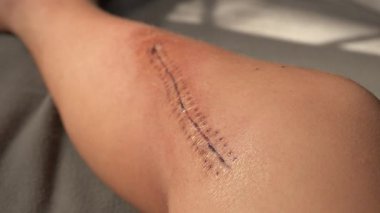 Ameliyat izi olan bacağın yan görüntüsü. Yüksek kalite 4k görüntü