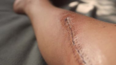 Kalçasında ameliyat izi olan bir bacak. Yüksek kalite 4k görüntü