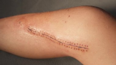Surgical scar along the thigh. High quality 4k footage