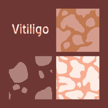 Vitiligo deri hastalığı. Kusursuz vektör deseni. Kendini sevme günün kutlu olsun. Çizgi film karalama tarzında Sağlık Sancağı konsepti. Vücudunun, yüzünün, elinin.